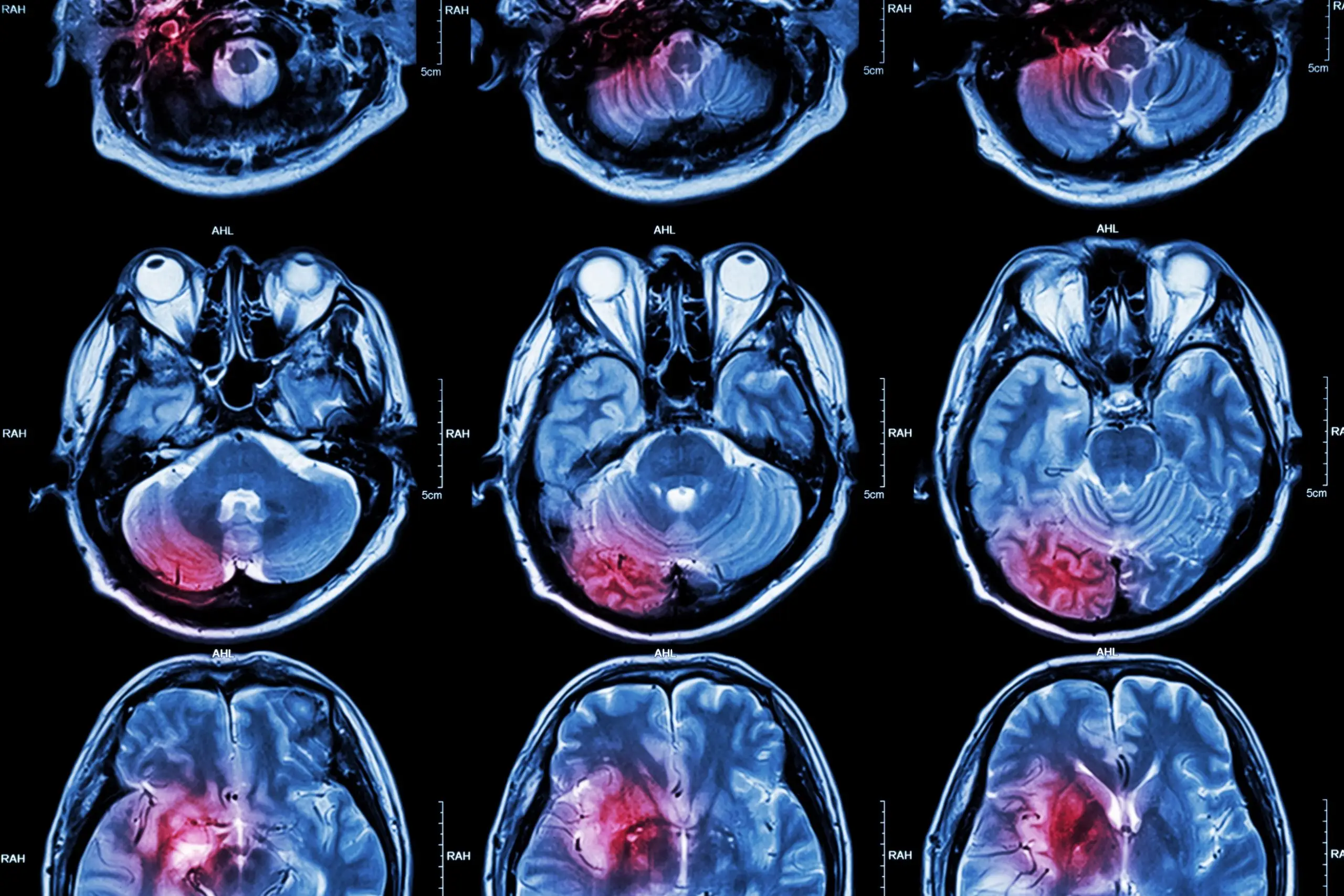 severe headache treatment process scaled