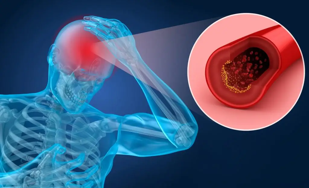 โรคหลอดเลือดสมอง (Stroke) คืออะไร สาเหตุ อาการ การรักษา