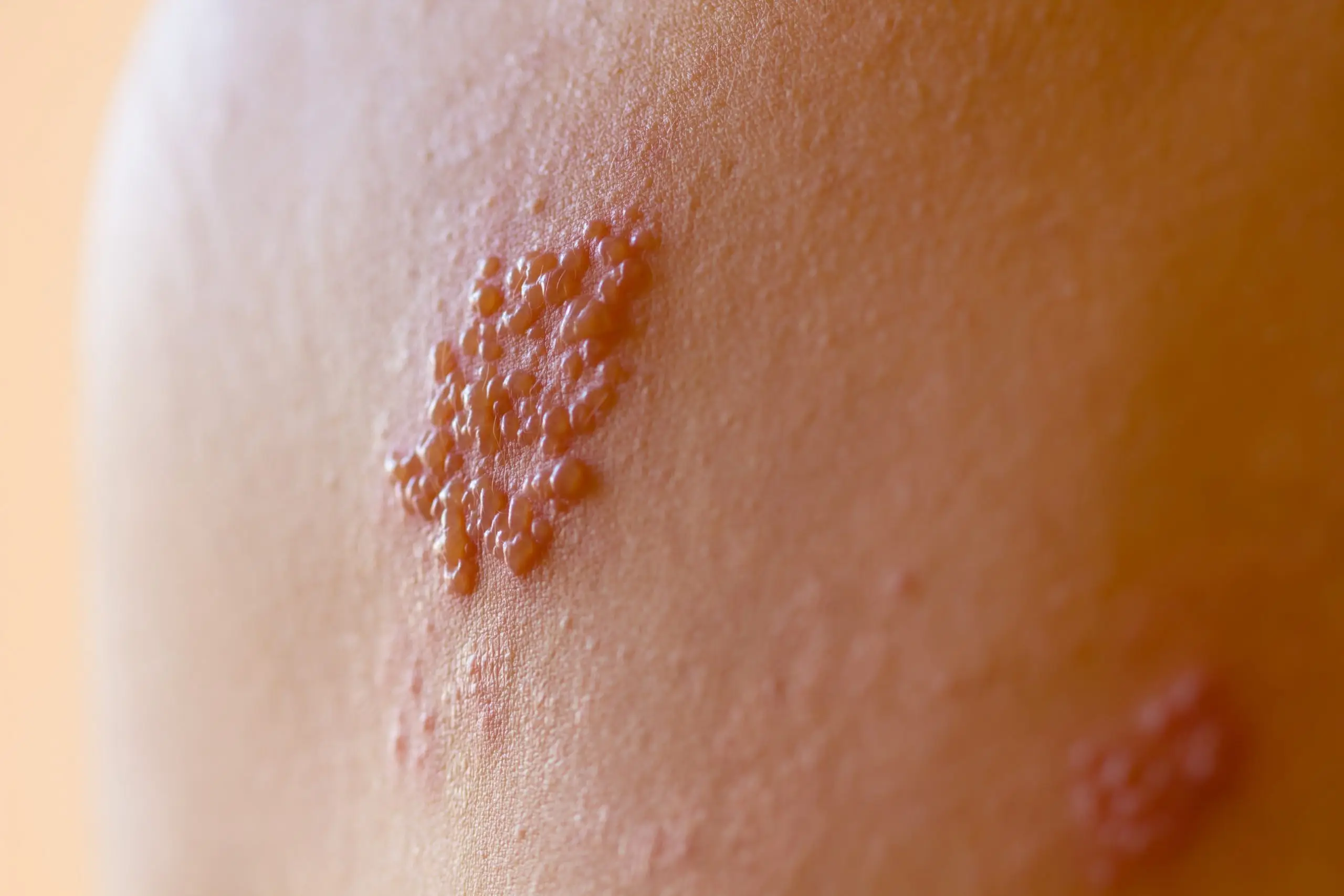 things to know before getting shingles vaccine disease faq scaled