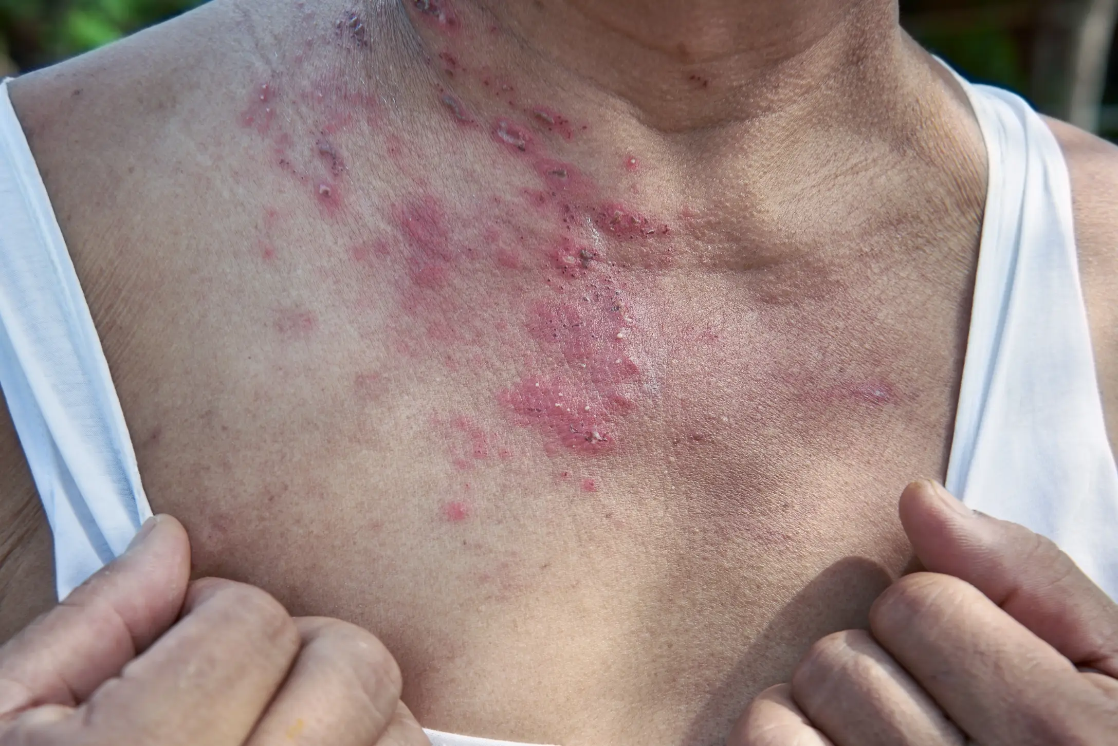 what is shingles and how is it prevented disease definition