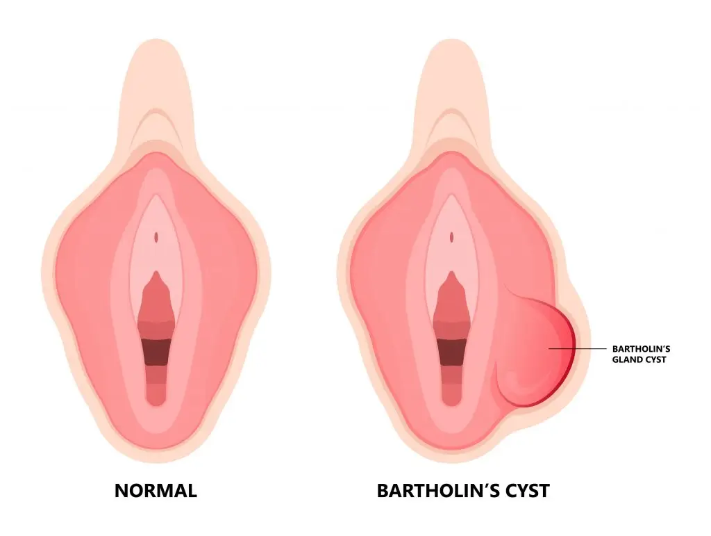 ปวด แสบช่องคลอด คลำเจอถุงน้ำ มีหนอง เสี่ยงเป็นฝีต่อมบาร์โธลิน