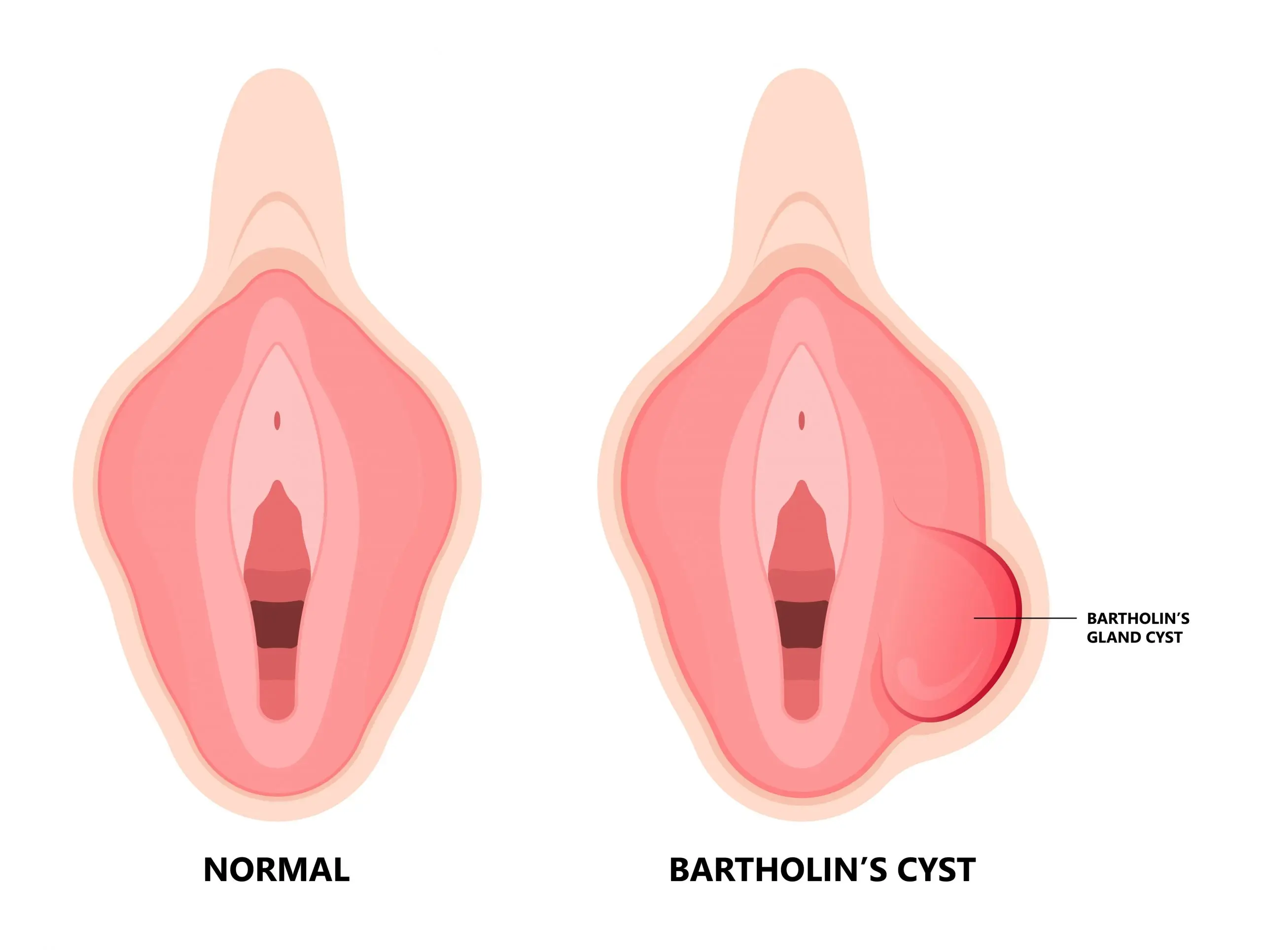 bartholin cyst disease definition scaled