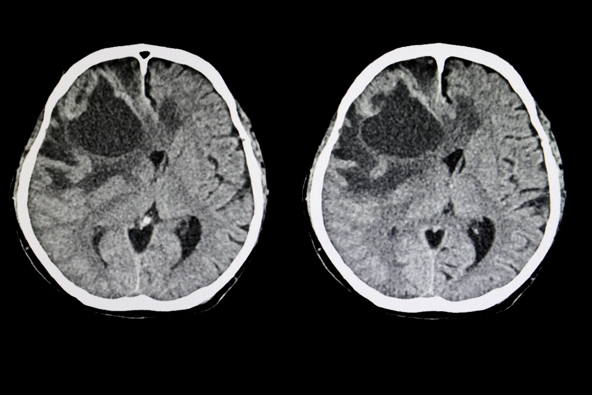 brain tumor disease definition