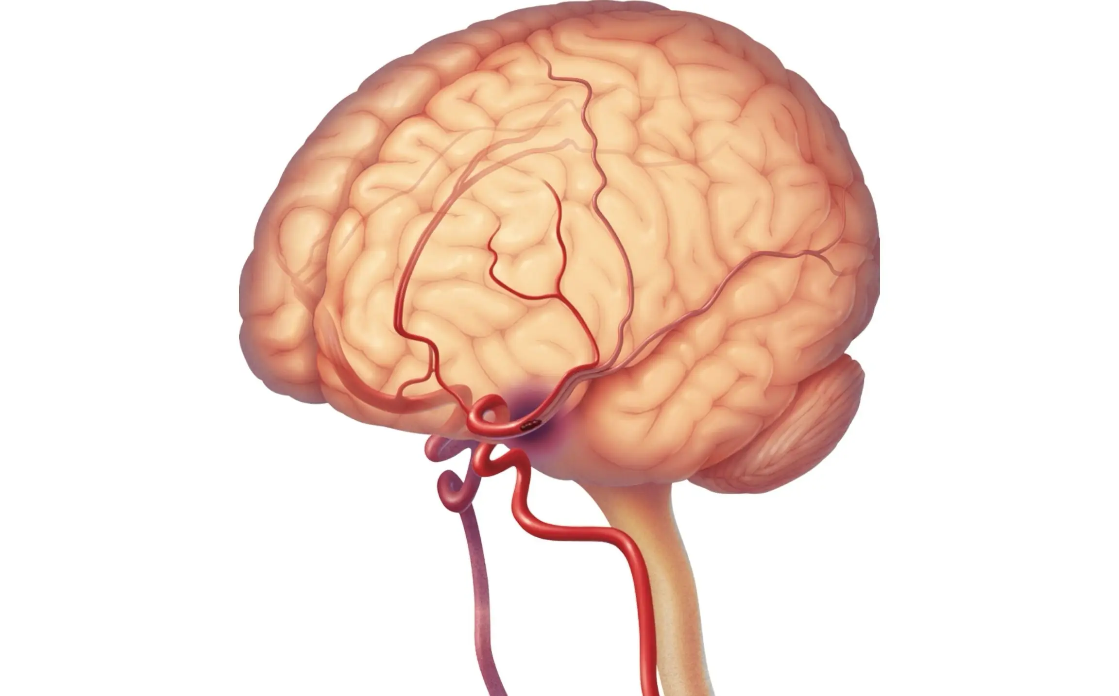 carotid artery disease definition