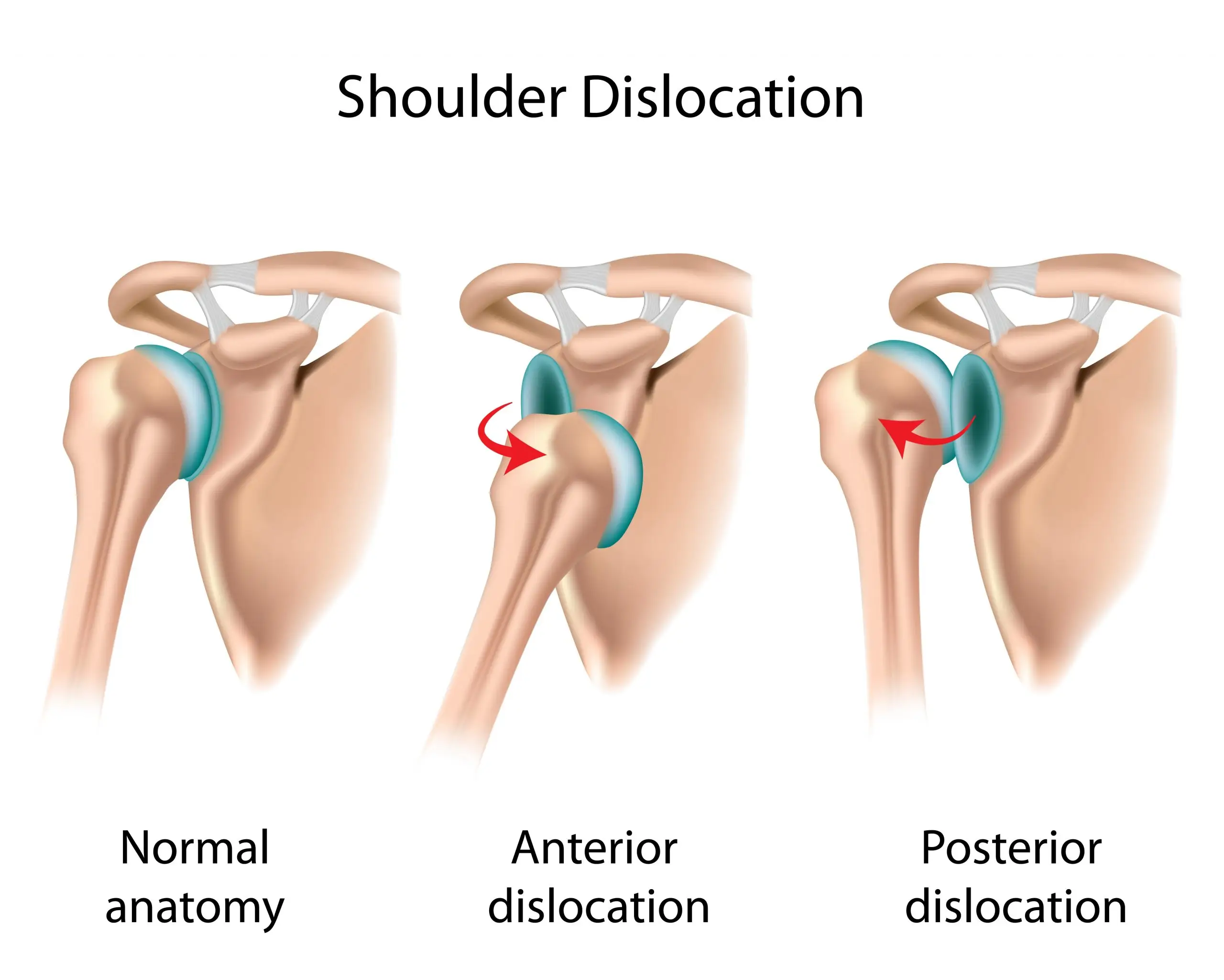 dislocated shoulder disease definition scaled