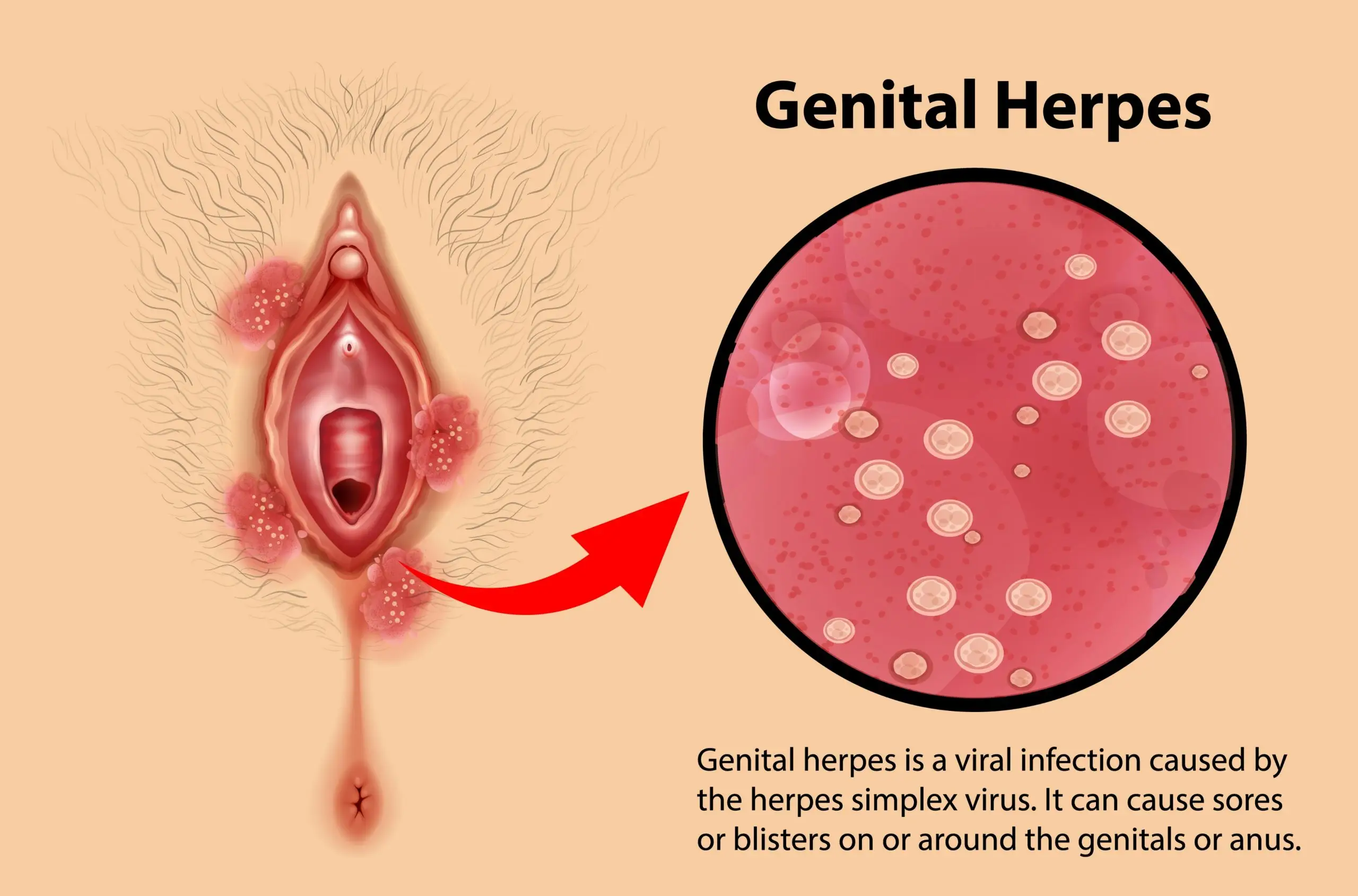 female genital herpes disease definition scaled