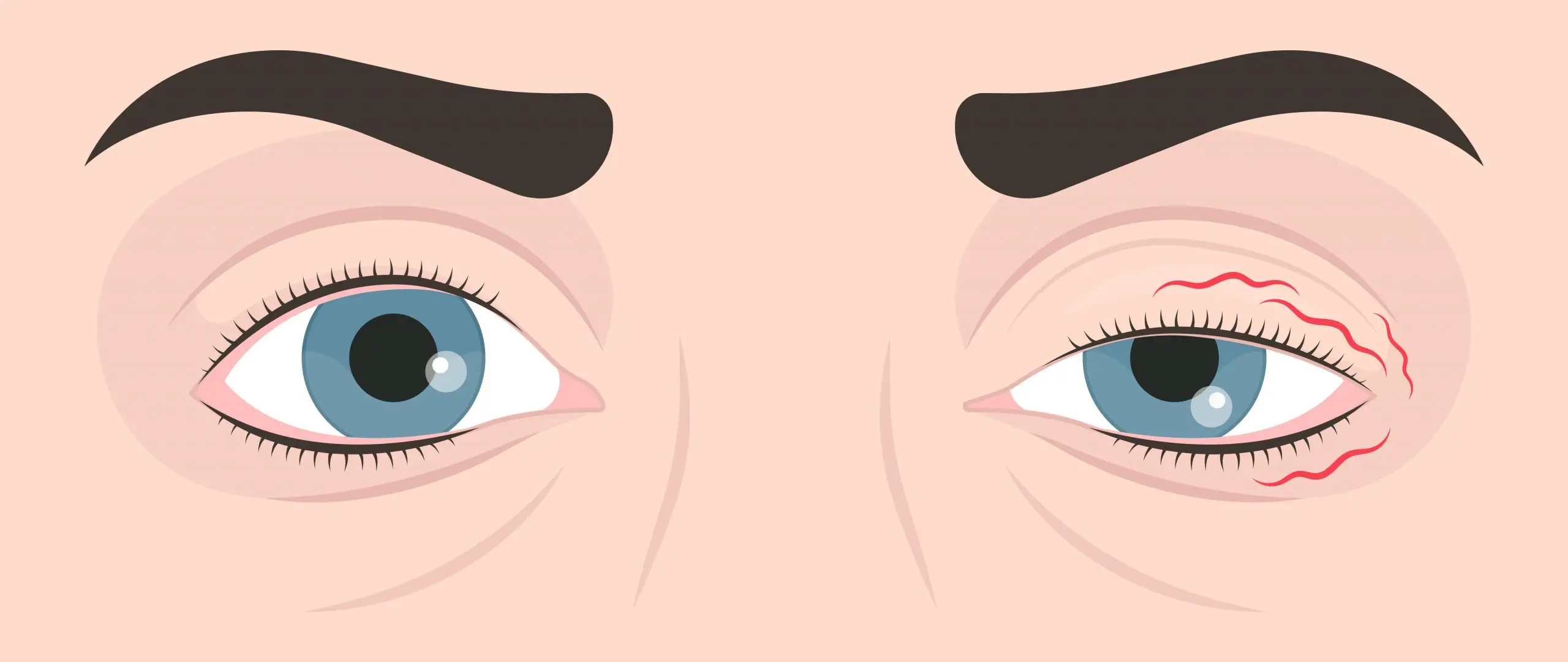 hemifacial spasm disease definition scaled