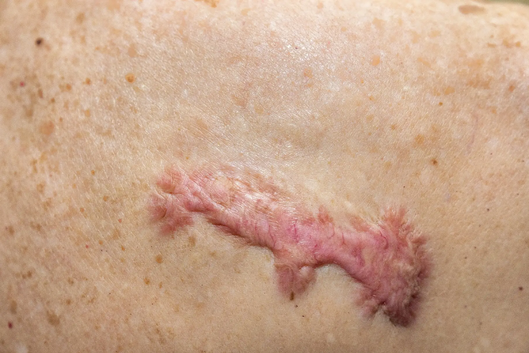 keloid and treatments disease definition