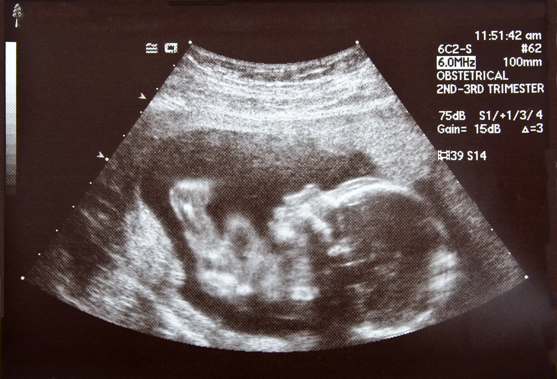 nt scan during pregnancy screening process