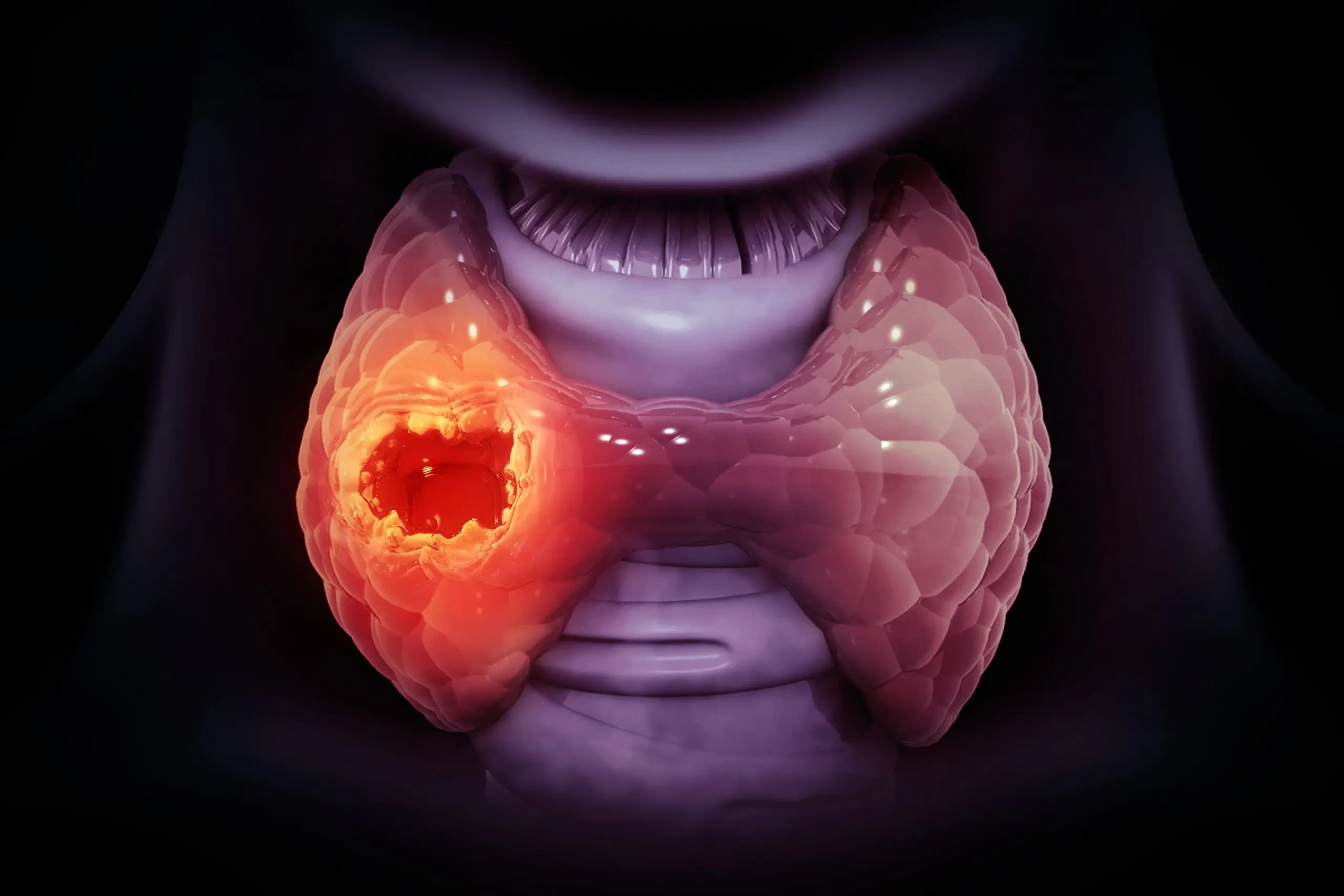 risk factors of thyroid cancer disease definition scaled