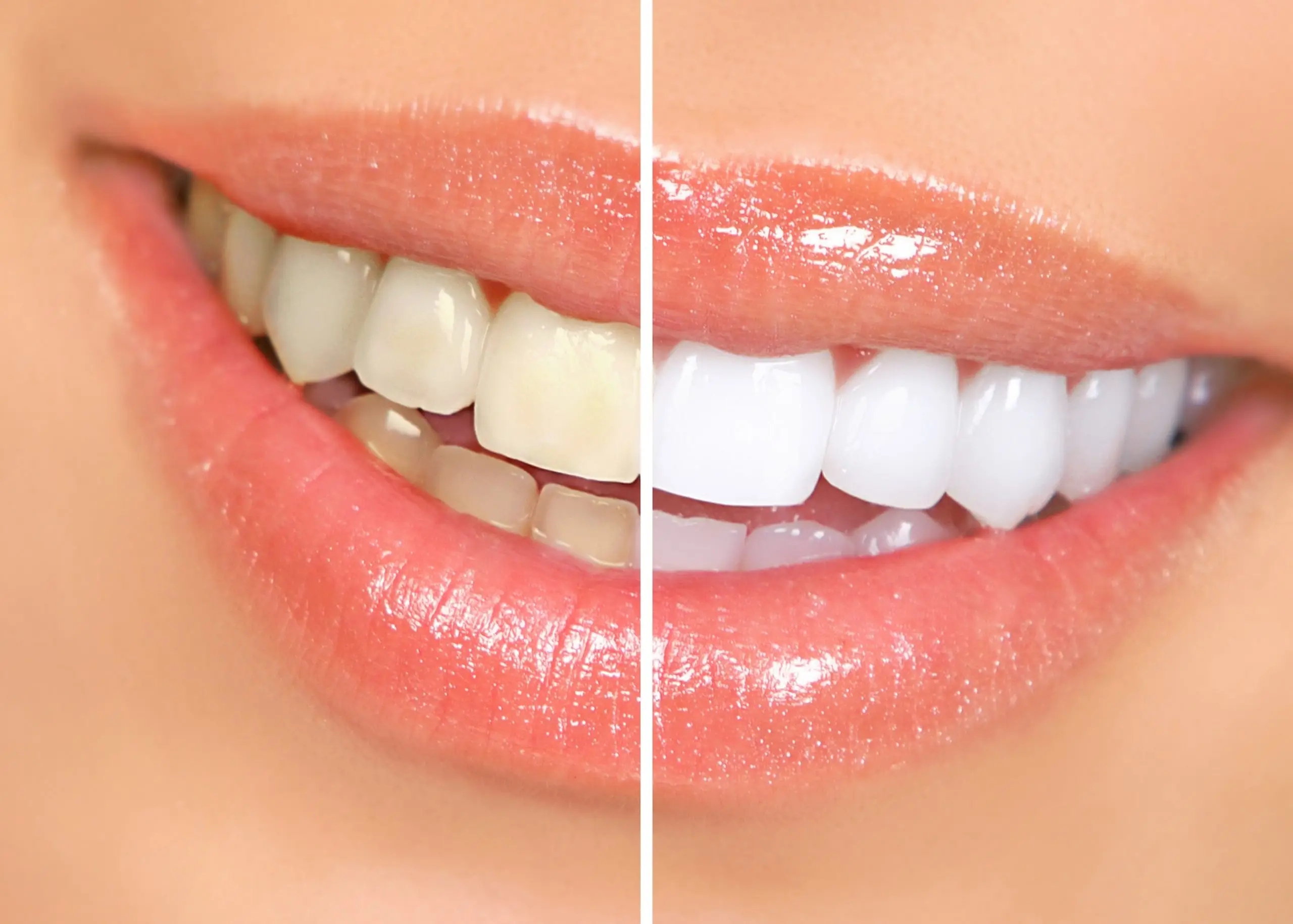 things to know before whitening teeth treatment faq scaled