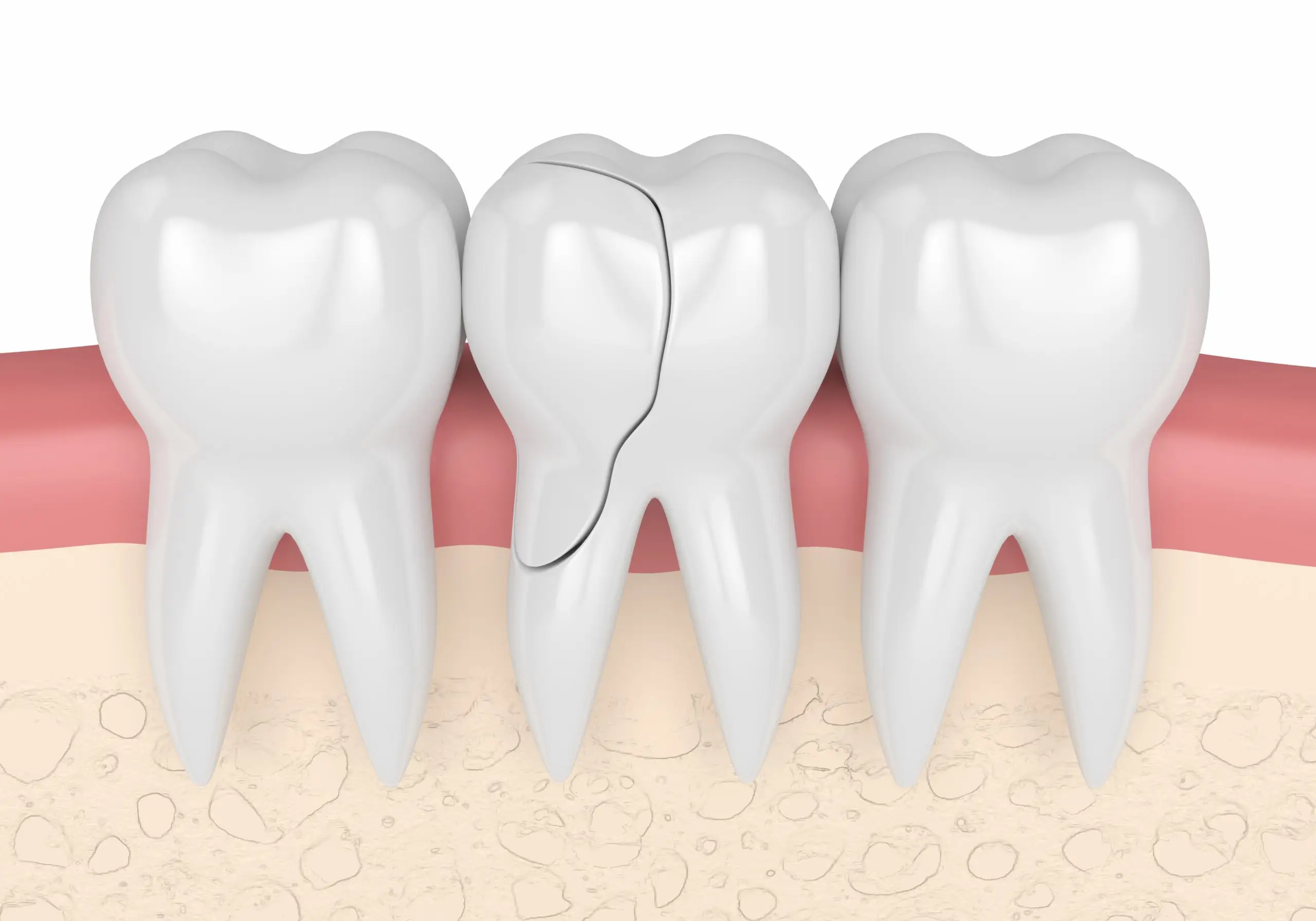 what to do if you have a fractured molar tooth disease definition scaled