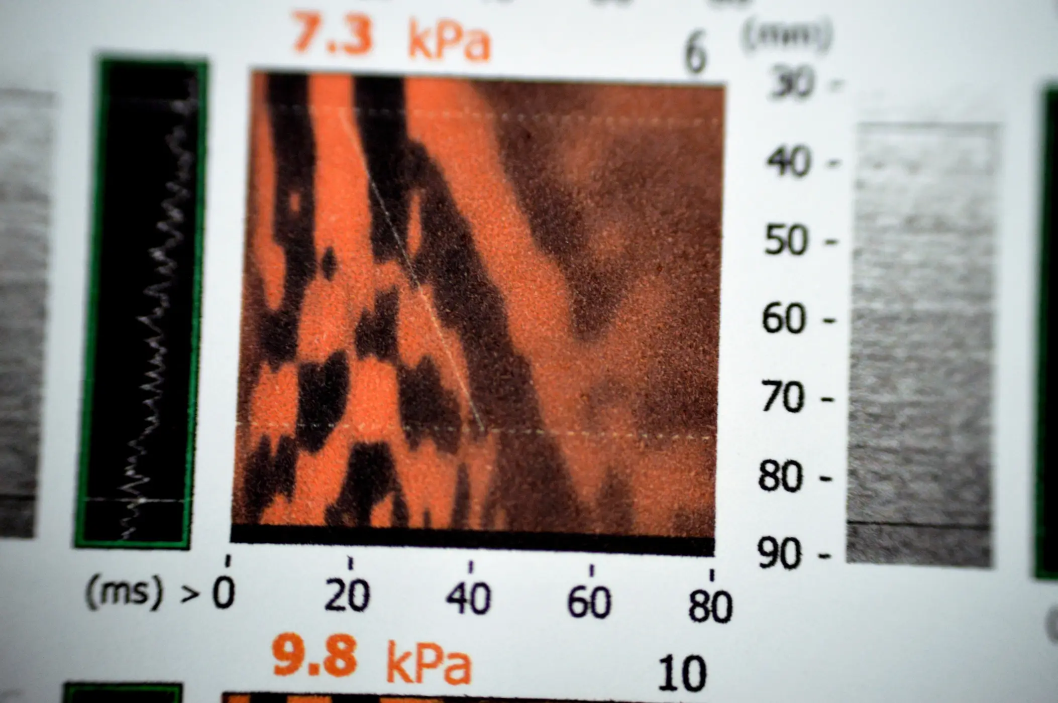 why need a fibroscan screening when to get check