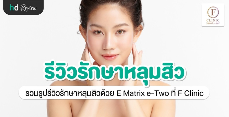 รีวิว รักษาหลุมสิวด้วย E Matrix e-Two ที่ F Clinic