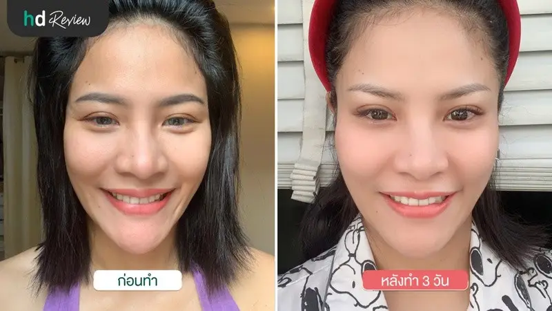 รีวิว ฉีดโบท็อกซ์ ลดริ้วรอย ที่ Zenzen Clinic