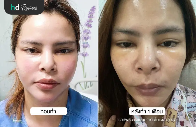ภาพเปรียบเทียบก่อนทำและหลังทำ 1 เดือน