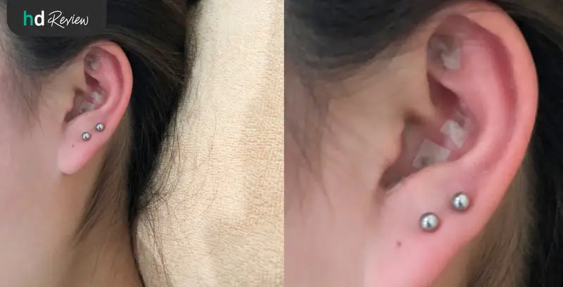 รีวิว ฝังเข็มปรับสมดุล ครอบแก้ว ติดหมุดใบหู ที่ Mandarin Clinic 6 รีวิว ฝังเข็มปรับสมดุล ครอบแก้ว ติดหมุดใบหู ที่ Mandarin Clinic