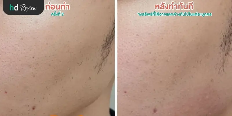 ยิงเลเซอร์ Cool Glide กระชับรูขุมขน ที่บีบีคลินิก (BB Clinic) 9 ภาพก่อนและหลังทำ Cool Glide Laser ทันที