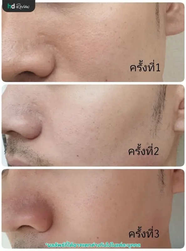 ยิงเลเซอร์ Cool Glide กระชับรูขุมขน ที่บีบีคลินิก (BB Clinic) 10 ภาพเปรียบเทียบหลังทำ Cool Glide Laser ครบ 3 ครั้ง