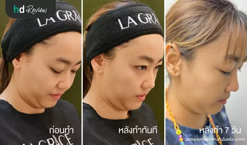 ผลลัพธ์หลังทำ Thermage FLX (เทอร์มาจ) ที่ La Grace Clinic