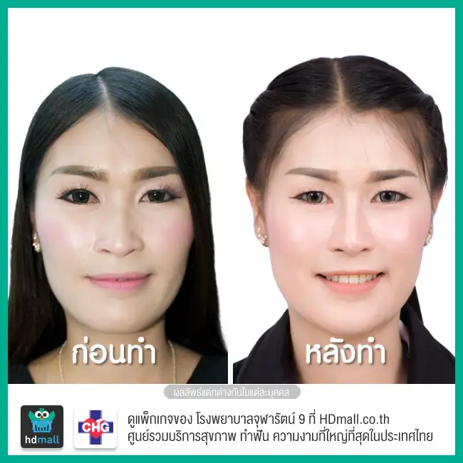 รีวิวศัลยกรรมจมูก ที่ โรงพยาบาลจุฬารัตน์ 9