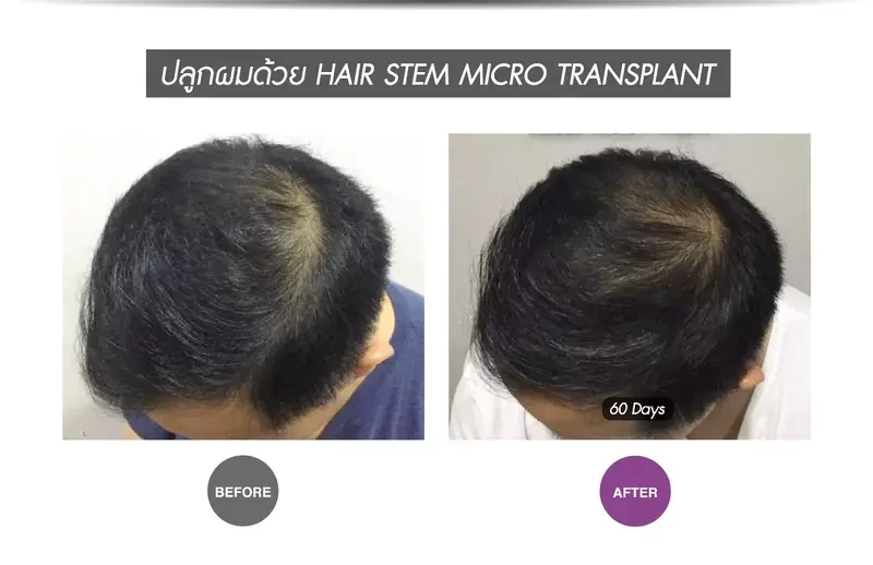Before After ปลูกผมแบบ Hair stem micro transplant ที่ APEX Medical Center