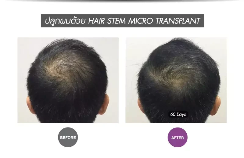 Before After ปลูกผมแบบ Hair stem micro transplant ที่ APEX Medical Center