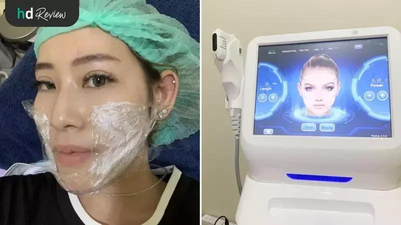 ภาพขั้นตอนการทำ HIFU Micro Lift ที่ Smon Clinic