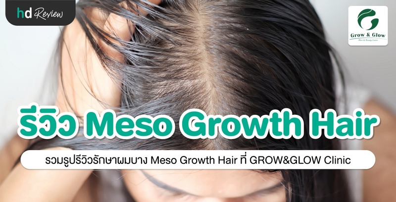 รีวิว รักษาผมบาง ด้วย Meso Growth Hair ที่ GROW & GLOW Clinic