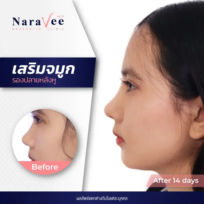 ณรวีคลินิก รีวิวจมูก