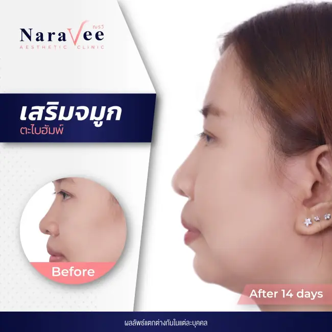 ณรวีคลินิก รีวิวจมูก