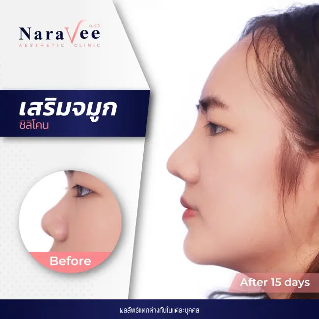ณรวีคลินิก รีวิวจมูก
