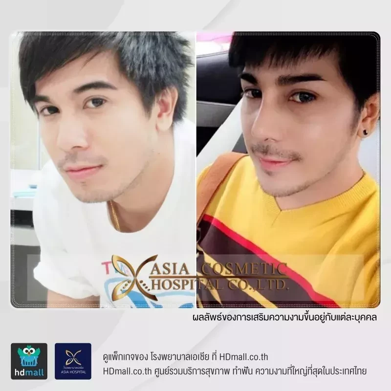 เสริมจมูกทรงหยดน้ำ ที่ โรงพยาบาลเอเซีย