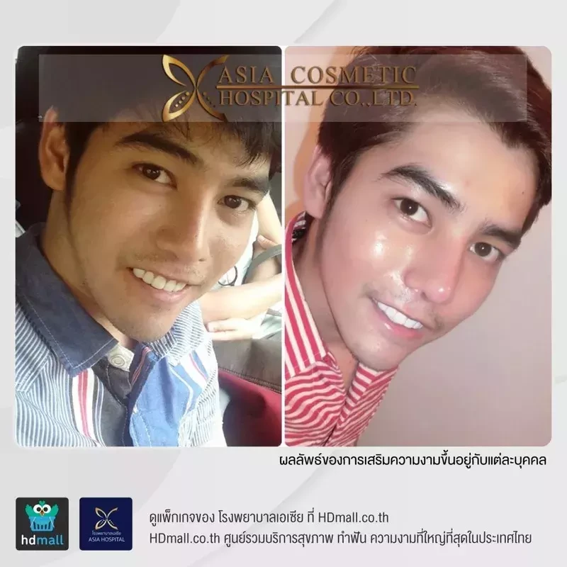 เสริมจมูกทรงหยดน้ำ ที่ โรงพยาบาลเอเซีย