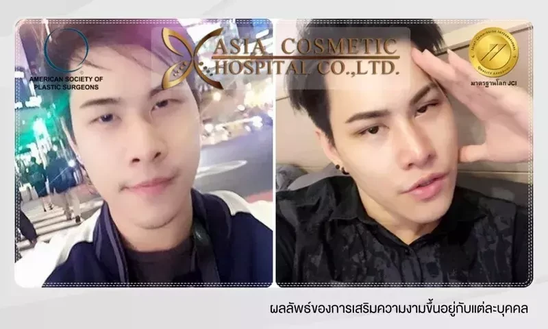 เสริมจมูกทรงหยดน้ำ ที่ โรงพยาบาลเอเซีย