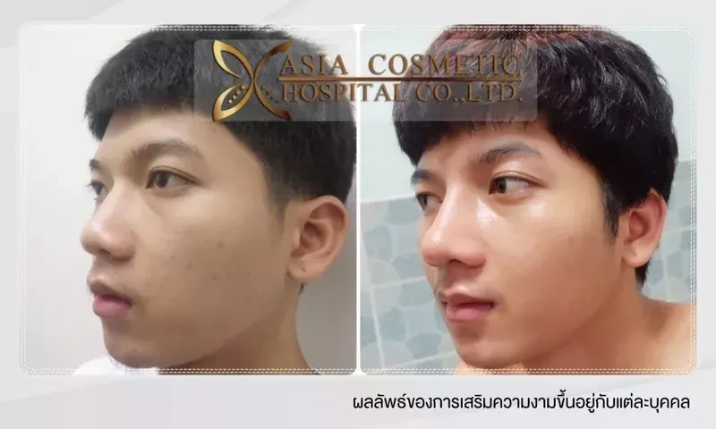 เสริมจมูกทรงหยดน้ำ ที่ โรงพยาบาลเอเซีย