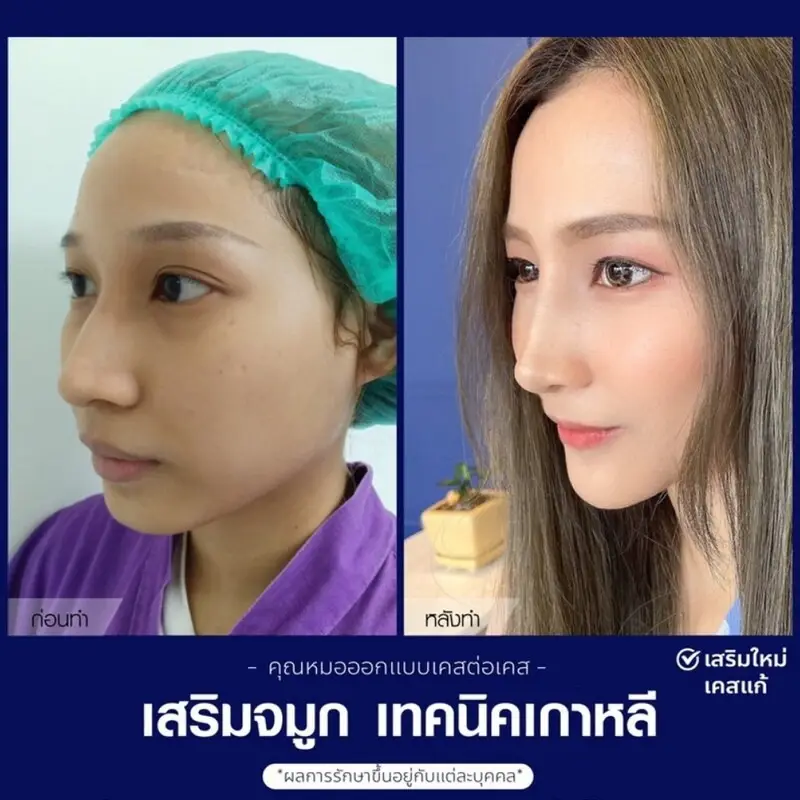รีวิว เสริมจมูกทรงปลายเชิด ที่ The East Clinic