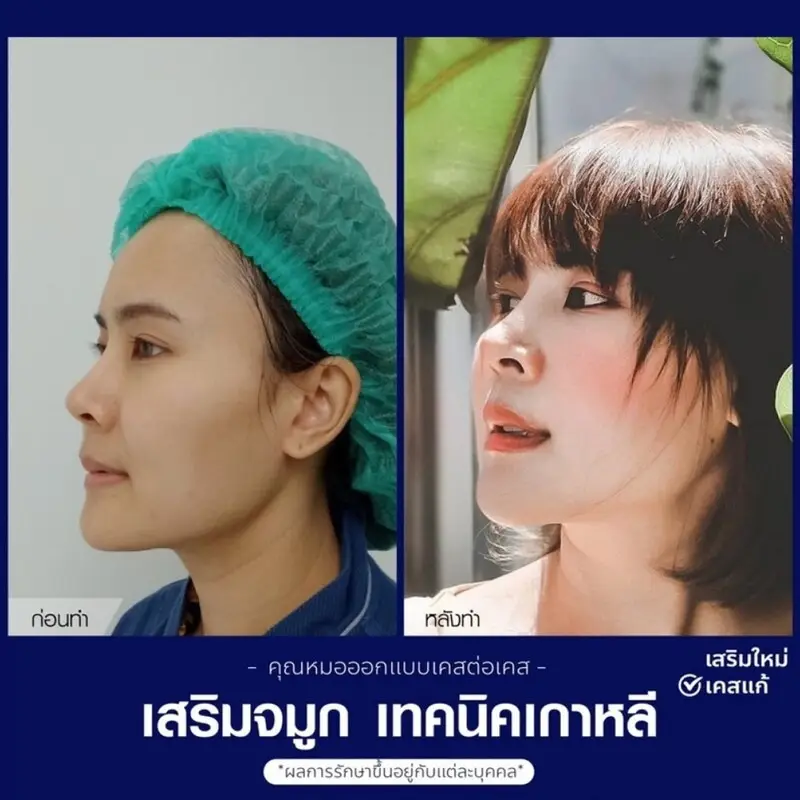 รีวิว เสริมจมูกทรงปลายเชิด ที่ The East Clinic
