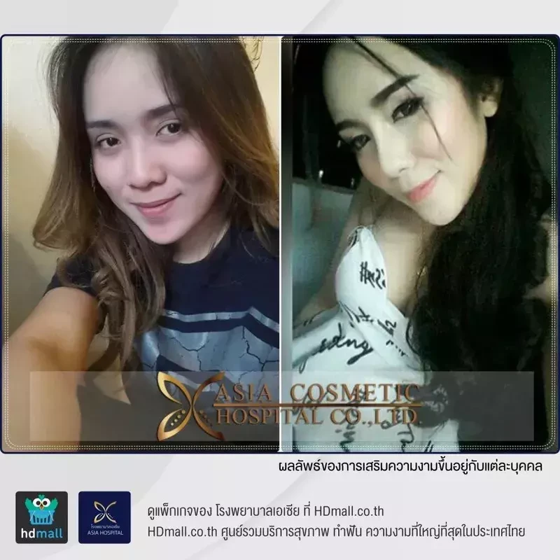 เสริมจมูกทรงหยดน้ำ ที่ โรงพยาบาลเอเซีย