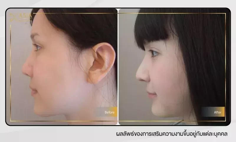 เสริมจมูกทรงหยดน้ำ ที่ โรงพยาบาลเอเซีย