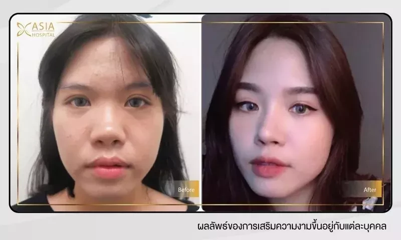 เสริมจมูกทรงหยดน้ำ ที่ โรงพยาบาลเอเซีย