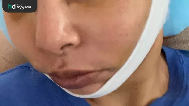 ภาพหลังผ่าตัดดึงหน้า ขูดซิลิโคนหน้า ที่ โรงพยาบาลยันฮี