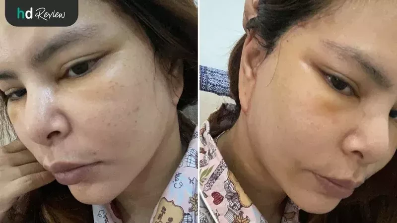 ภาพหลังผ่าตัดดึงหน้า ขูดซิลิโคนหน้า 1 อาทิตย์