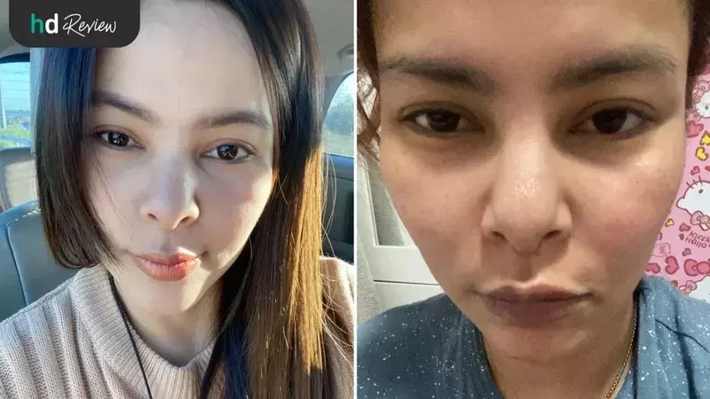 ภาพผู้ใช้บริการก่อนผ่าตัดดึงหน้า ขูดซิลิโคนหน้า ที่ โรงพยาบาลยันฮี