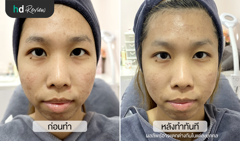 ก่อนและหลังรักษาสิว ที่ Kawintra Clinic แบริ่ง