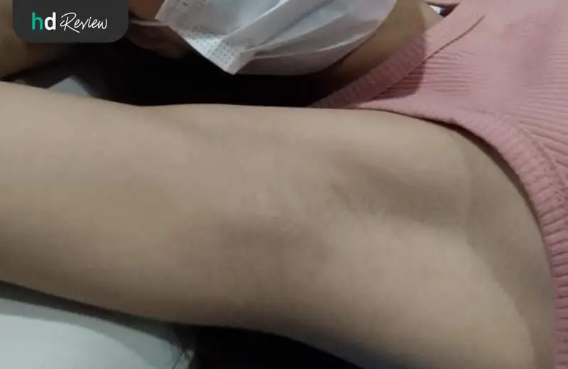 รีวิว กำจัดขนรักแร้ ด้วย Elos Laser Advance Diode ที่ Gangnam Clinic