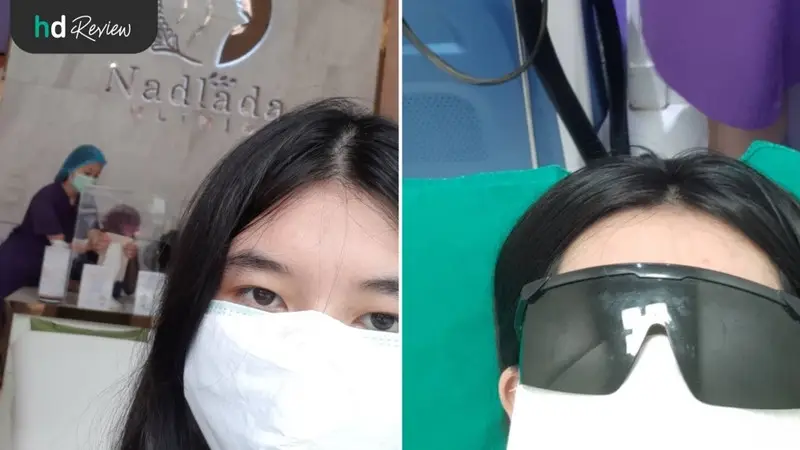content review armpit laser yag at nadlada clinic by aksarapak si 3