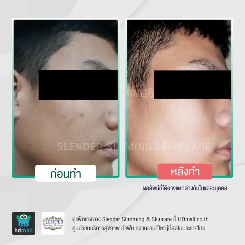 รีวิว รักษาสิว ด้วย Acne Light Laser ที่ Slender Slimming & Skincare