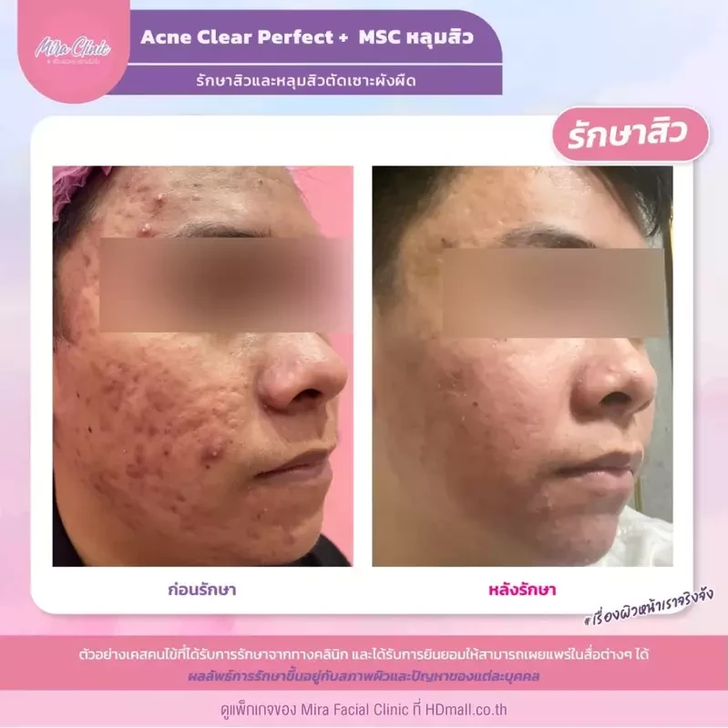 รีวิว รักษาสิว ที่ Mira Facial Clinic