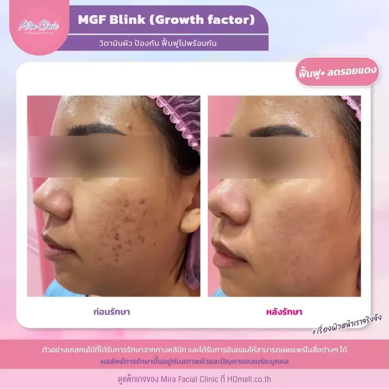 รีวิว รักษาสิว ที่ Mira Facial Clinic